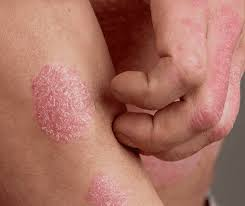 Psoriasis Treatment