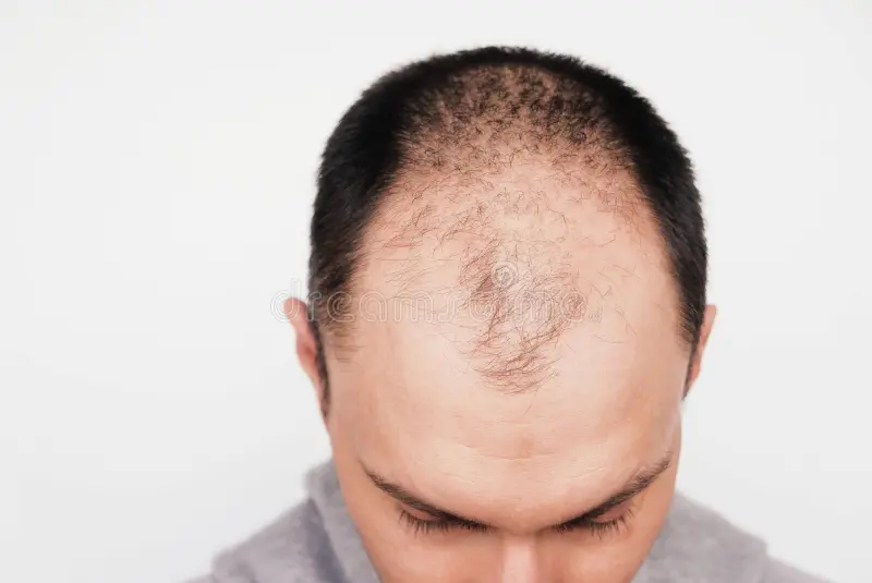 hair loss