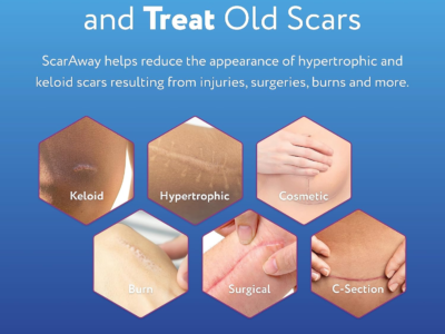 ScarAway Kelo-Cote Advanced Formula Scar Gel