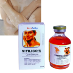 Vitiligo Gel White Spot Clear Anti Vitiligo cream Safed Daag