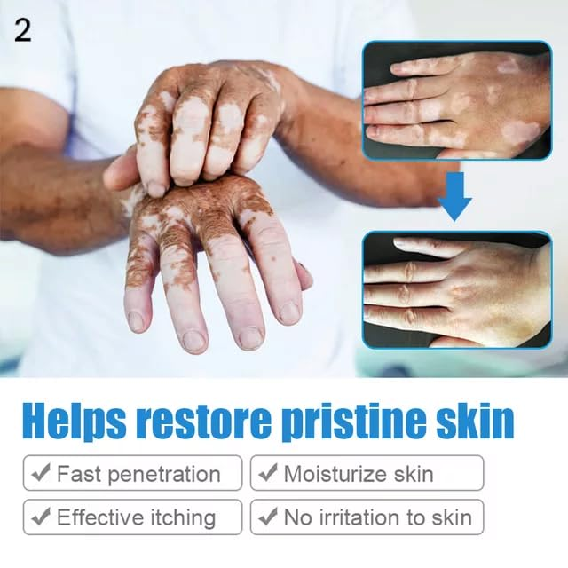 Vitiligo Gel White Spot Clear Anti Vitiligo cream - Image 3