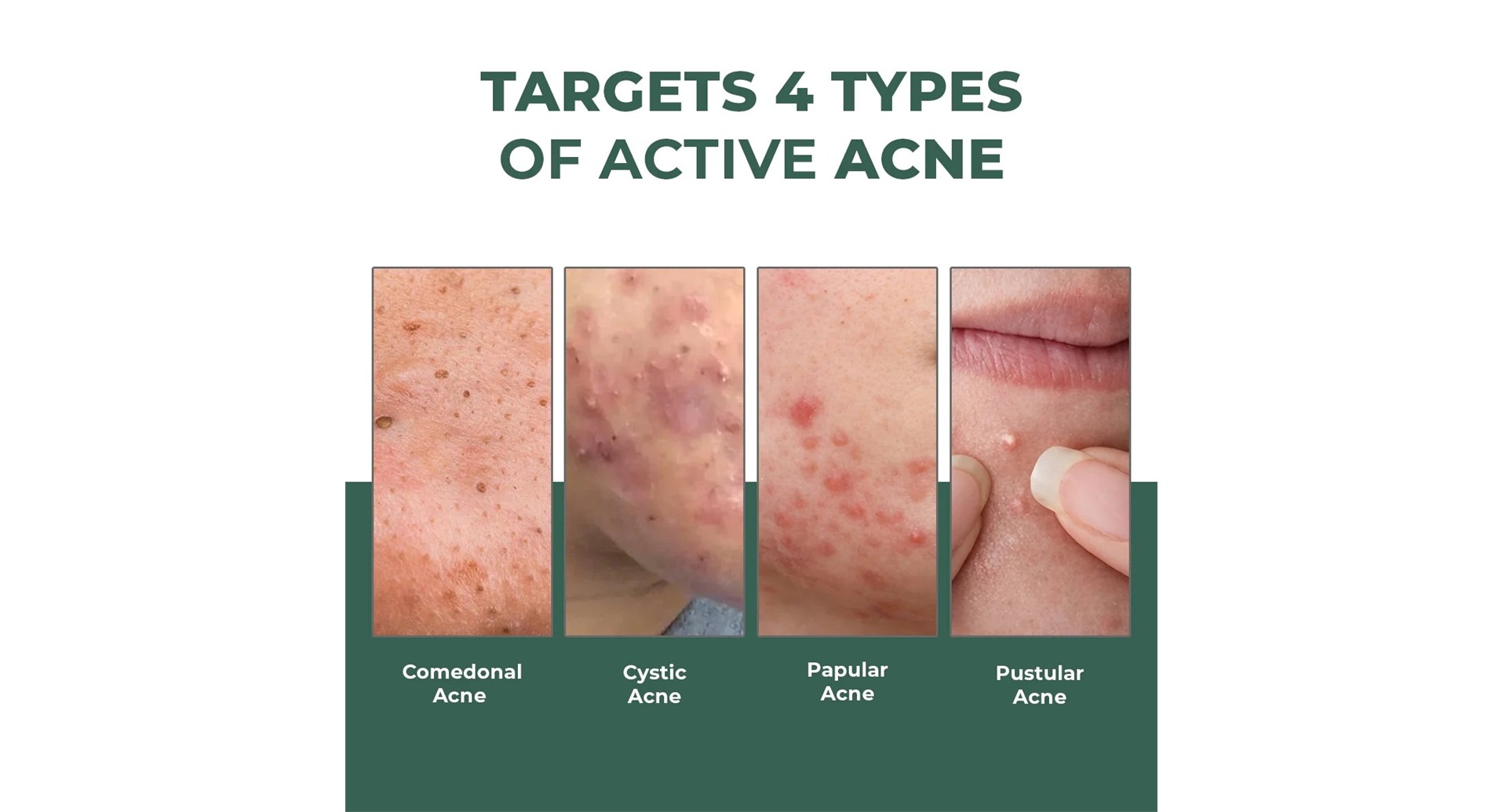 Conscious Chemist Rapid Relief Acne Spot Corrector Gel targets 4 types of active acne