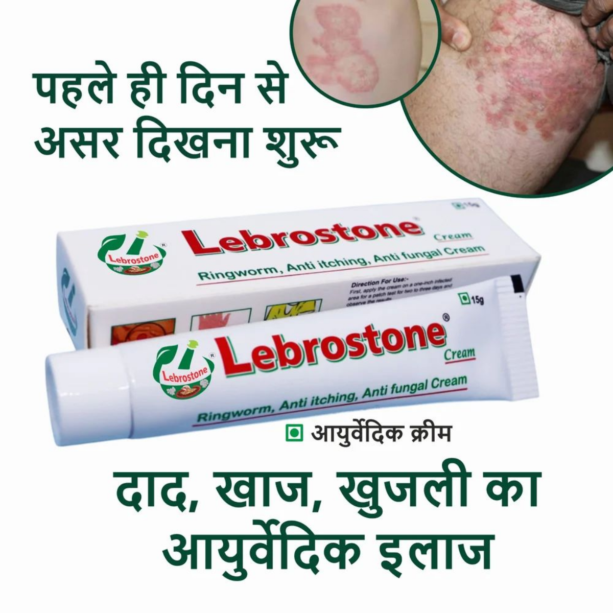 Lebrostone Cream tube and carton for ringworm and fungal infection