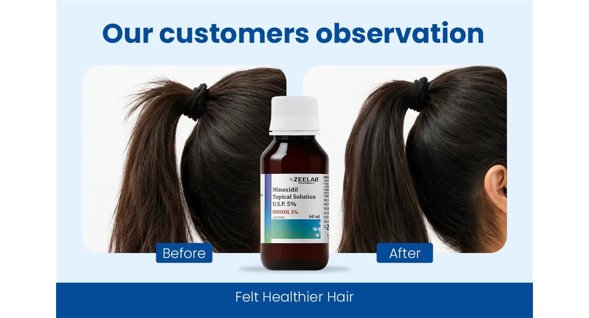 Minoxil 5% Topical Solution before and after results